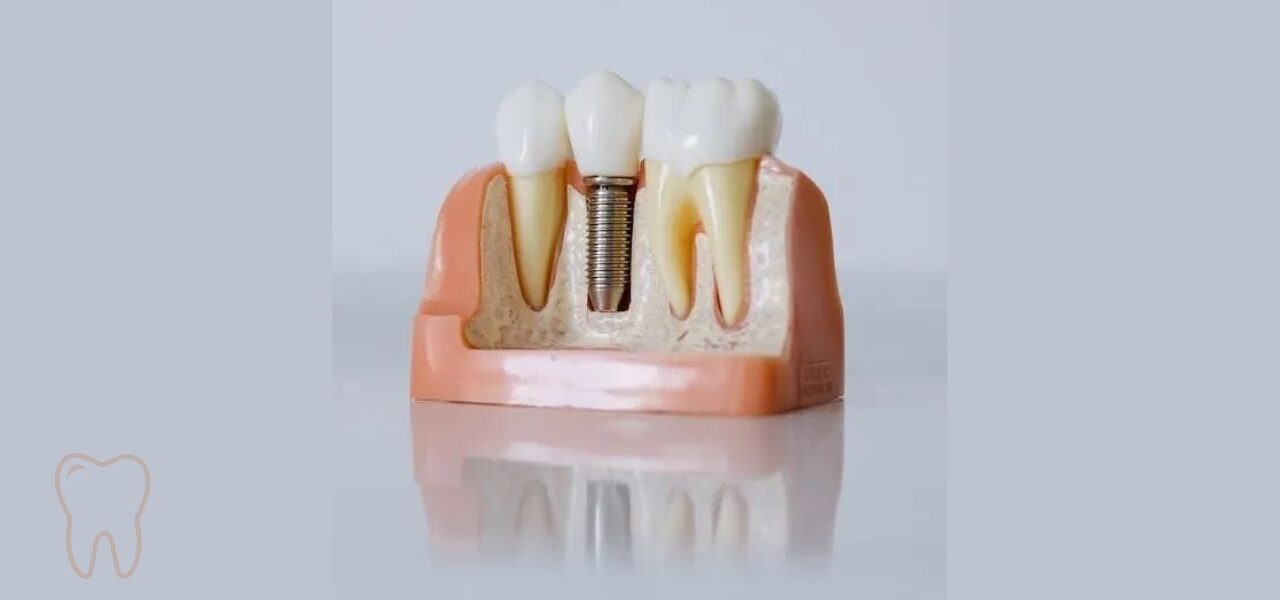 A Complete Guide About The Benefits Of Front Dental Implants